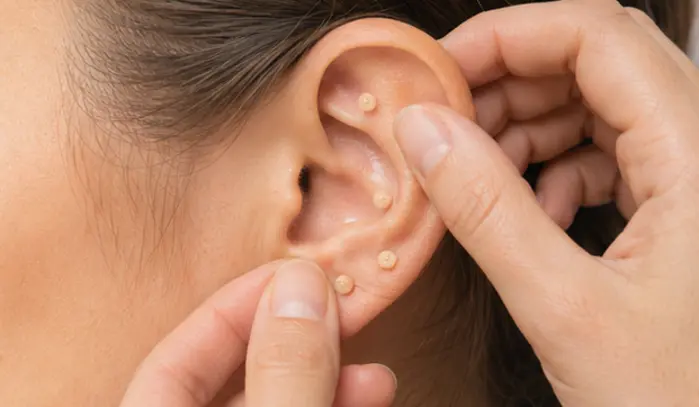 Aplicação de auriculoterapia na orelha